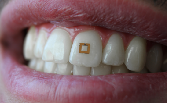 科學(xué)家開發(fā)出新型牙齒傳感器 可測量糖、鹽等的攝入量